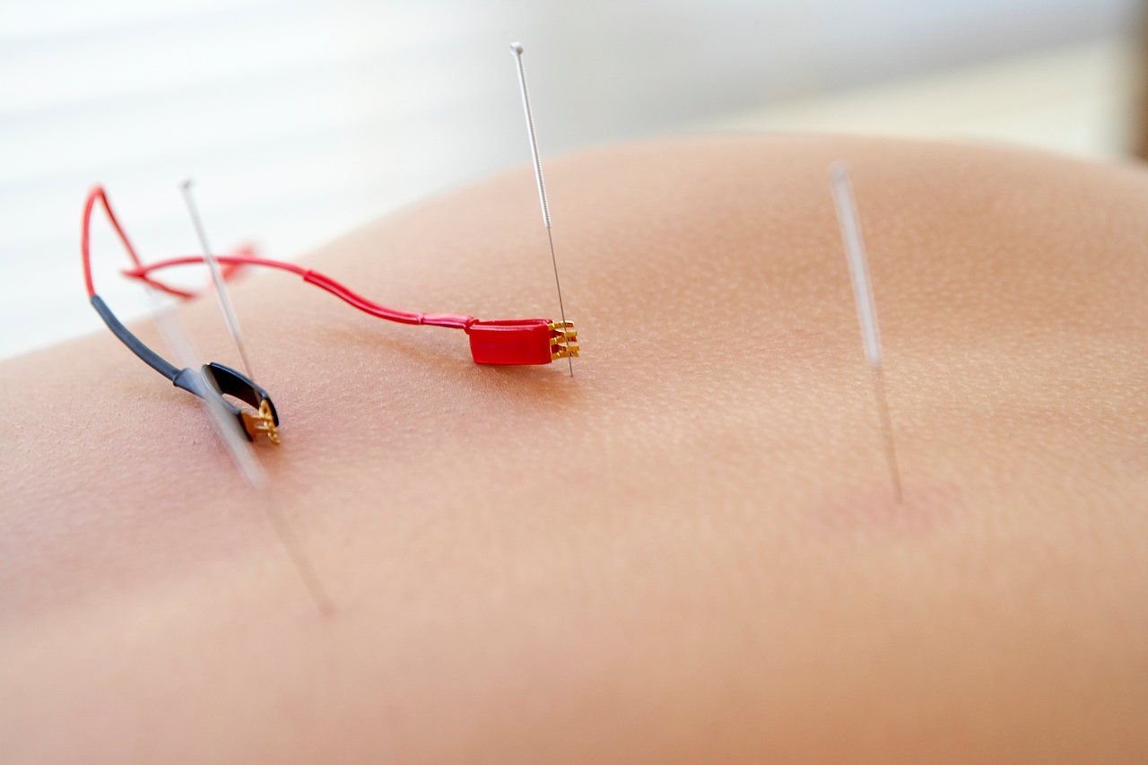 Acupuncture with Electrical Stimulation