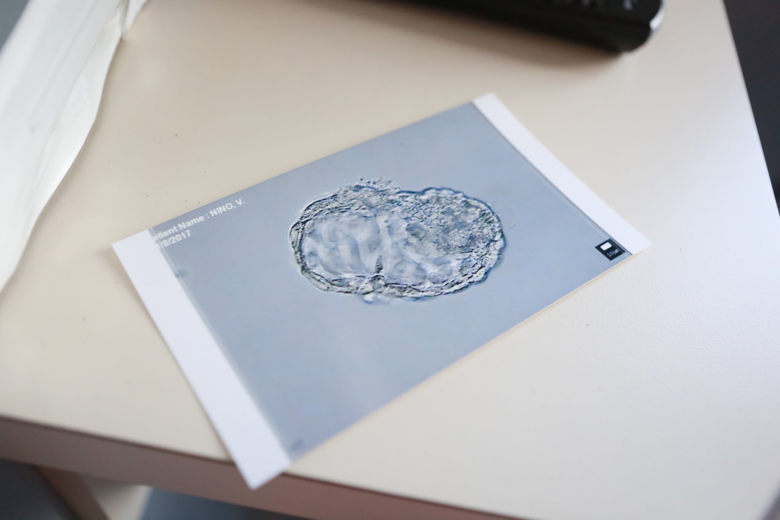 Acupuncture for Embryo Transfer (Fresh or Frozen)