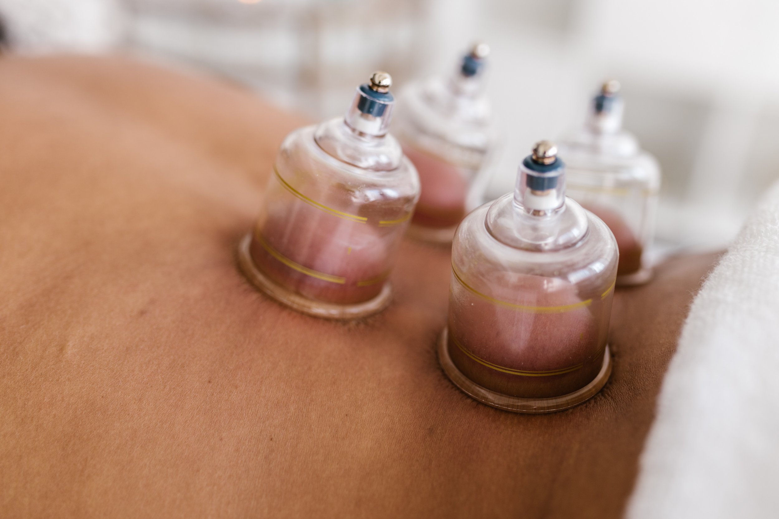 Cupping for Back Pain