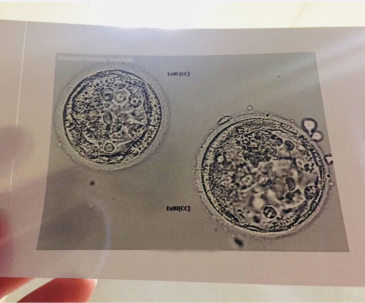 Acupuncture for In-Vitro Fertilization